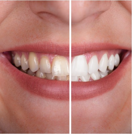 Sonrisa antes y después del blanqueamiento