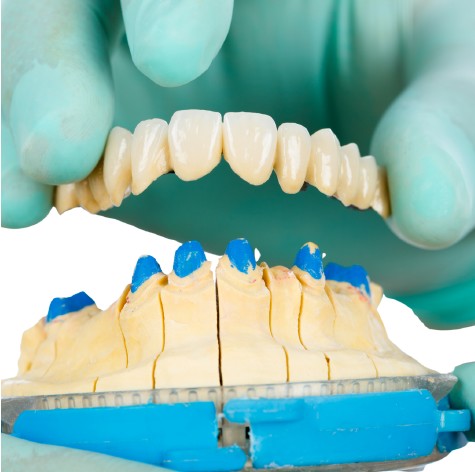 Puente dental sobre modelo
