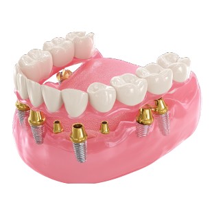 Prótesis sobre implantes dentales